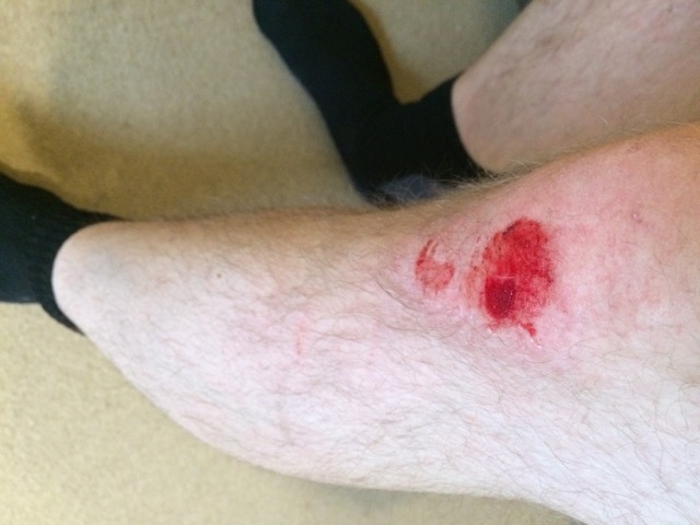 Luckily, minor injury to my knee